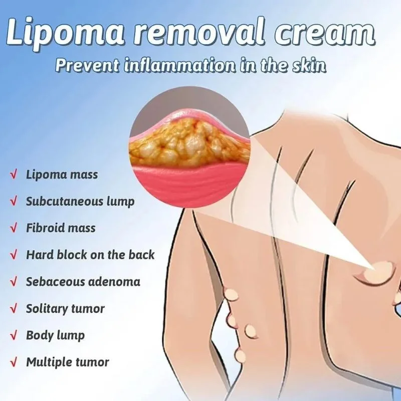 Lipoma Removal Cream | Herbal Skin Care Cream for Smooth & Nourished Skin | Fast-Absorbing Formula | For Neck & Body | 50g - Image 5